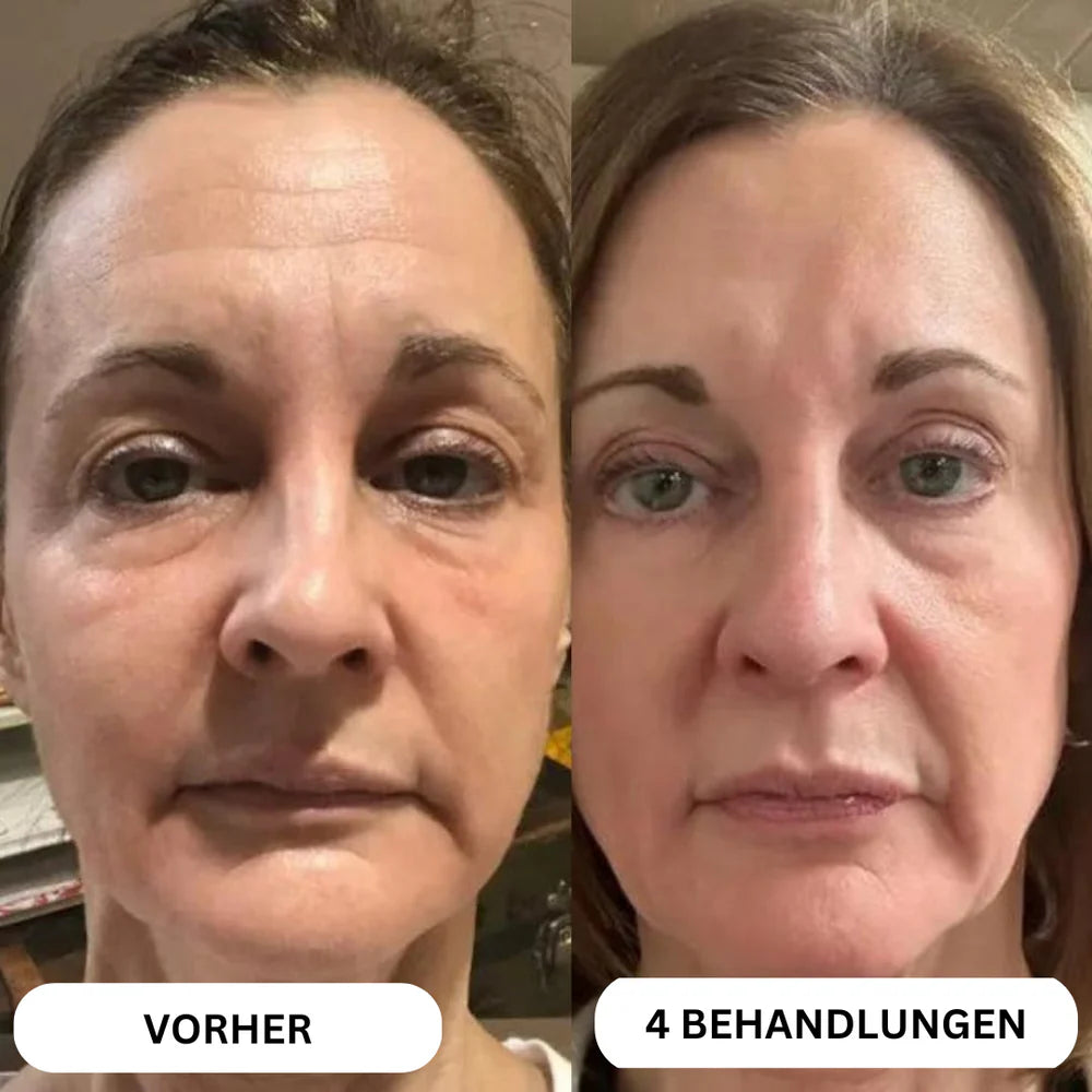 Natural Botulin 8-Week Microinfusion System™