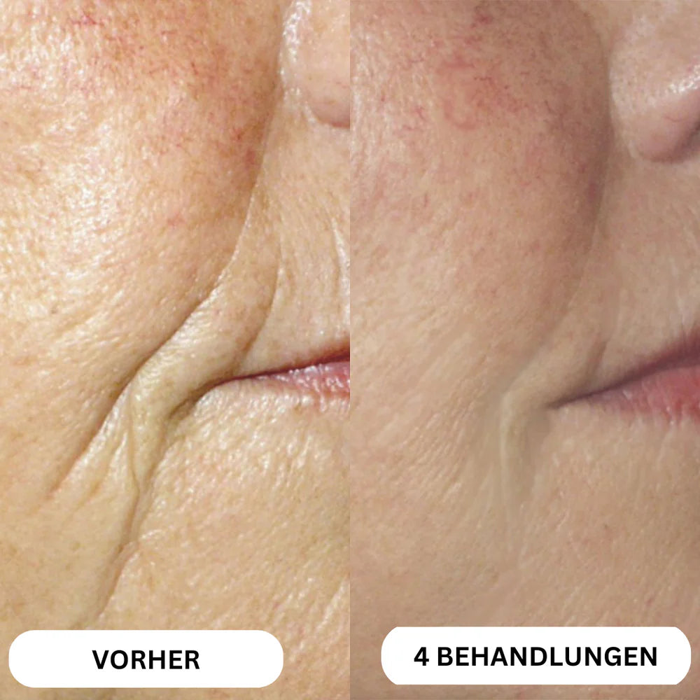 Natural Botulin 8-Week Microinfusion System™