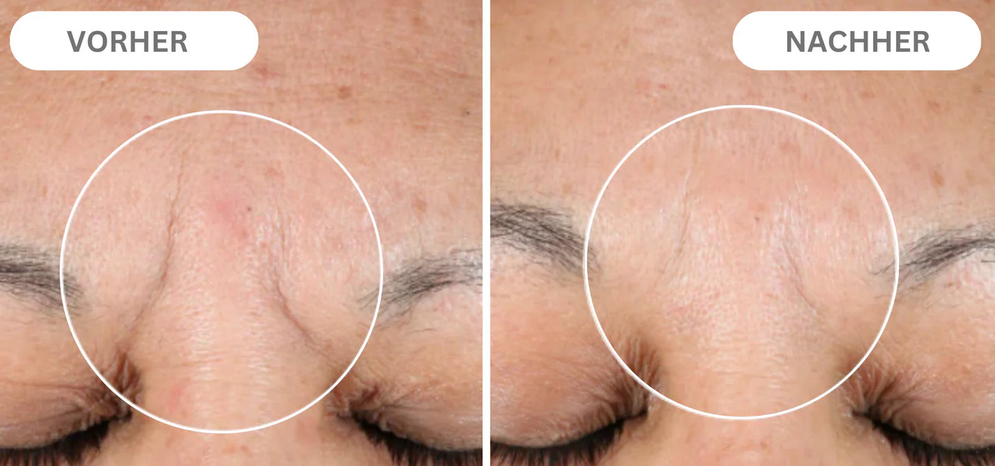 Natural Botulinum Facial Pads