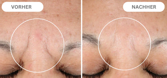 Natural Botulinum Facial Pads