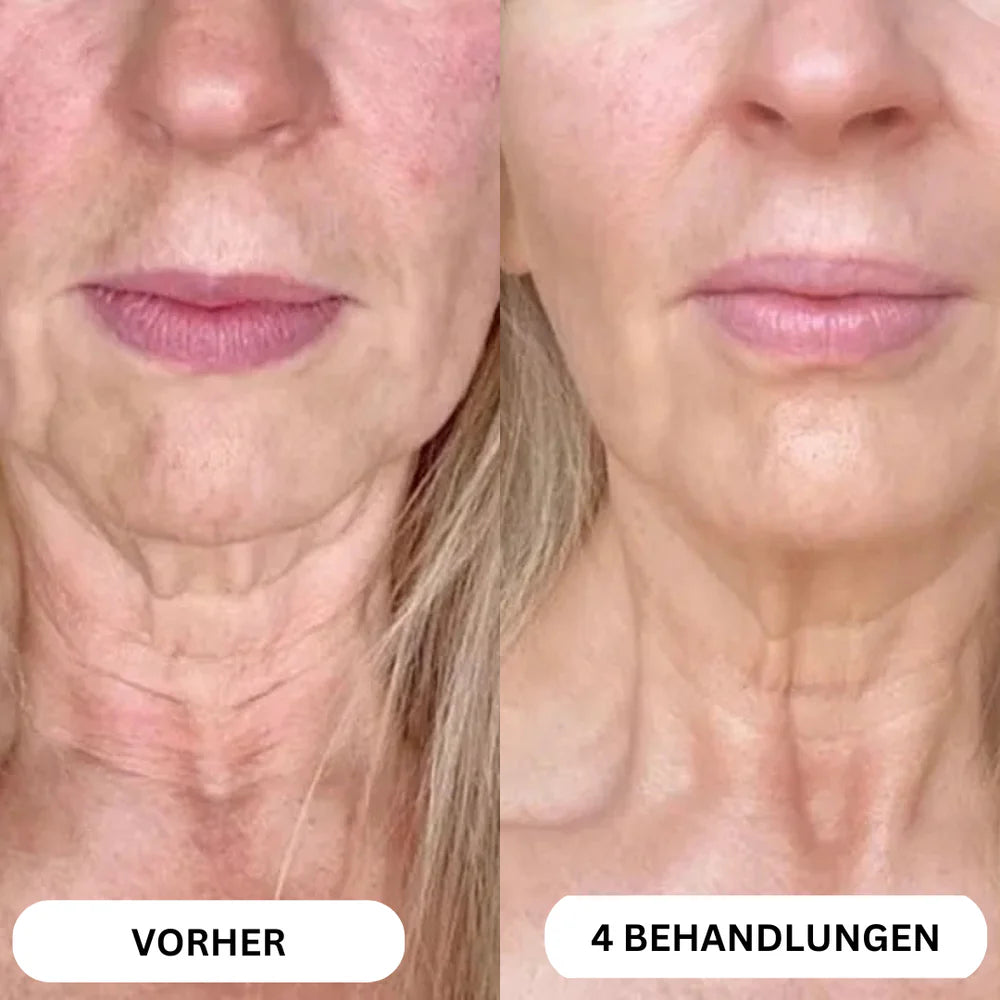 Natural Botulin 8-Week Microinfusion System™