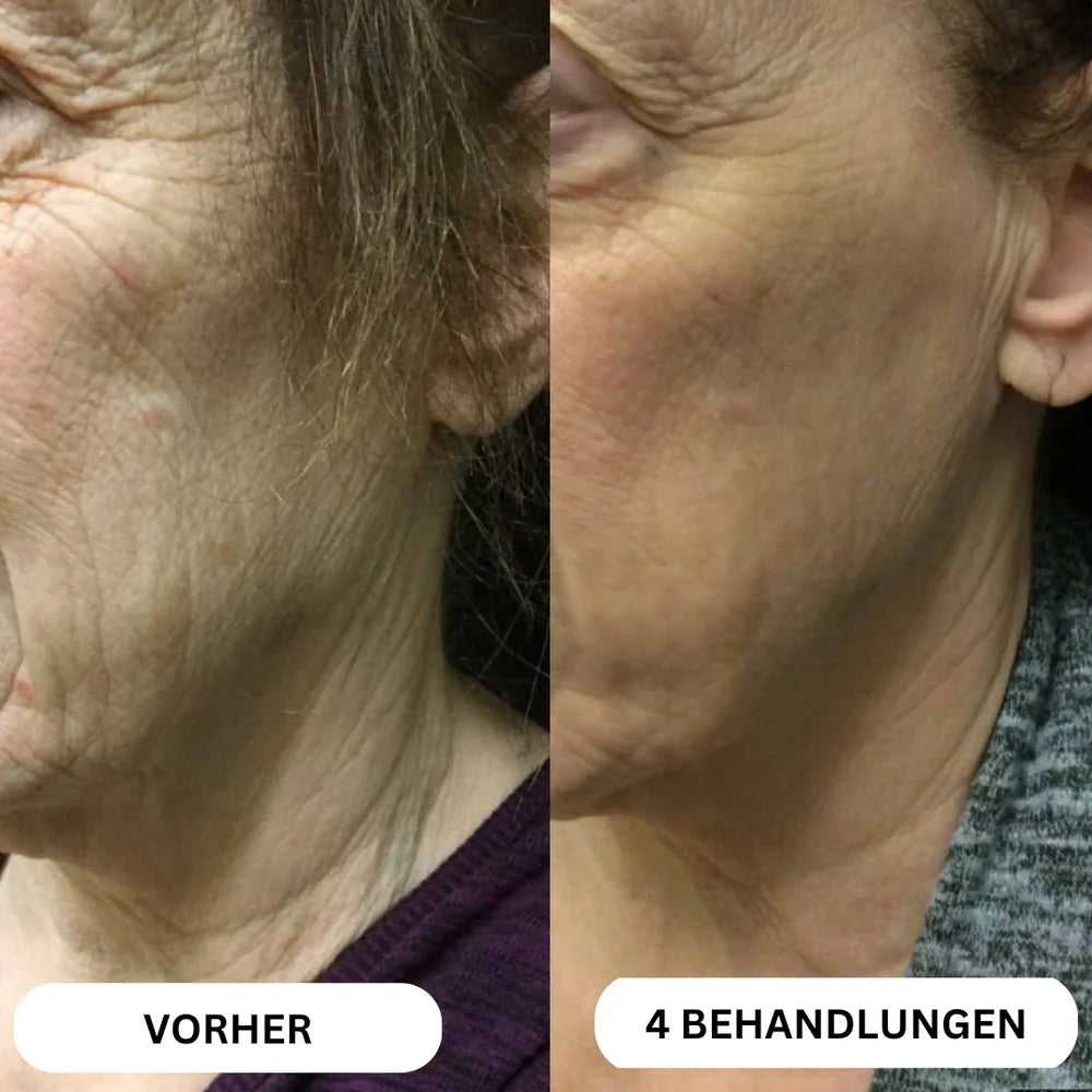 Natural Botulin 8-Week Microinfusion System™