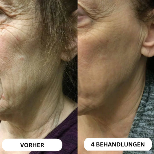 Natural Botulin 8-Week Microinfusion System™